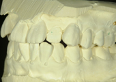 インプラント治療をより安全に行うために、歯科用CTを使用して顎の骨の精密な画像を撮ります